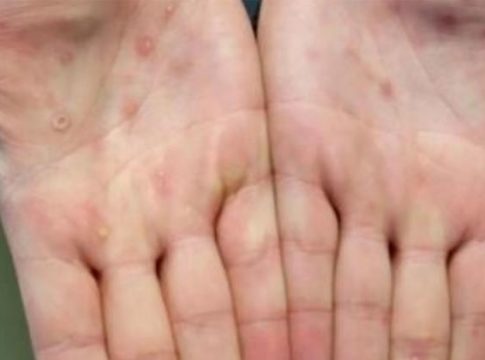 Vaccine Alliance signe un accord pour la fourniture de 500 000 doses de vaccin contre la variole du singe à l'Afrique