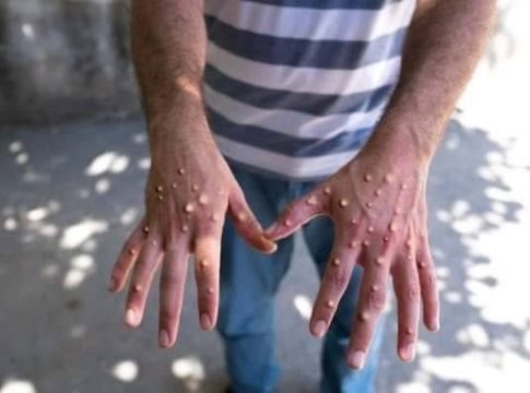 La Sierra Leone déclare une urgence sanitaire en réponse à l'épidémie de variole du singe