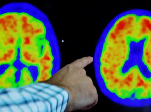 Des scientifiques identifient une variante génétique qui pourrait réduire le risque de maladie d'Alzheimer