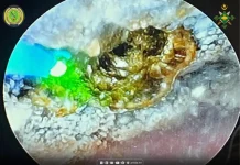L'hôpital militaire de Nouakchott reprend le traitement des calculs rénaux avec la technologie laser moderne