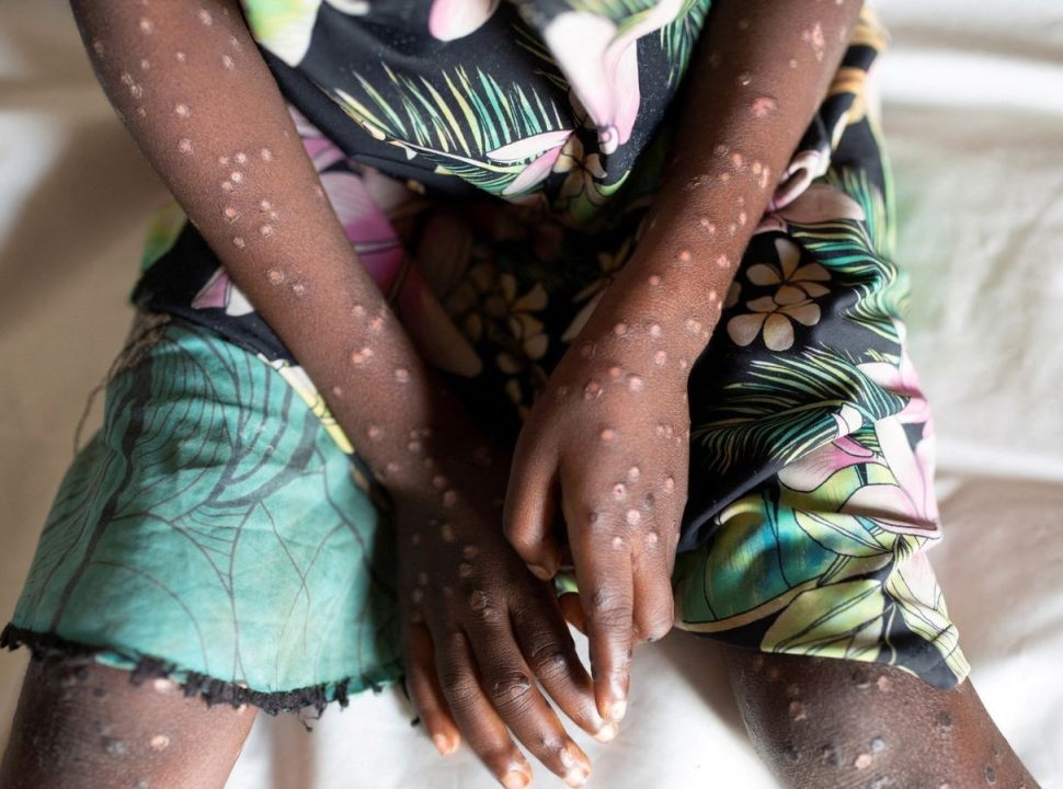 L'épidémie de variole du singe au Burundi pourrait cesser d'ici quelques semaines selon l’UNICEF