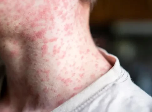 Maroc : Une flambée sans précédent du « Bouhamroun » et les autorités déclarent une épidémie